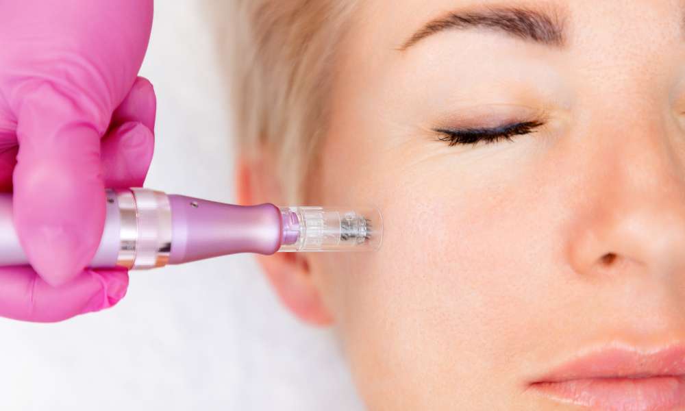 Rejuvenate and Renew: The Art of Microneedling for Radiant Skin